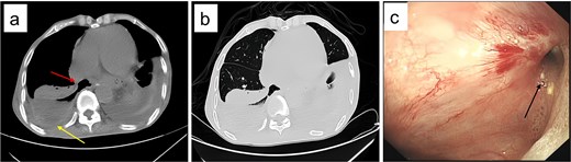 Post-admission chest CT and gastroscopy. (a) Mediastinal window showing esophageal fistula (arrow) and empyema (arrow); (b) lung window confirming the 67 × 36 × 117 mm right empyema; (c) gastroscopy identifying a 8 mm fistula (arrow) 38 cm from incisors.