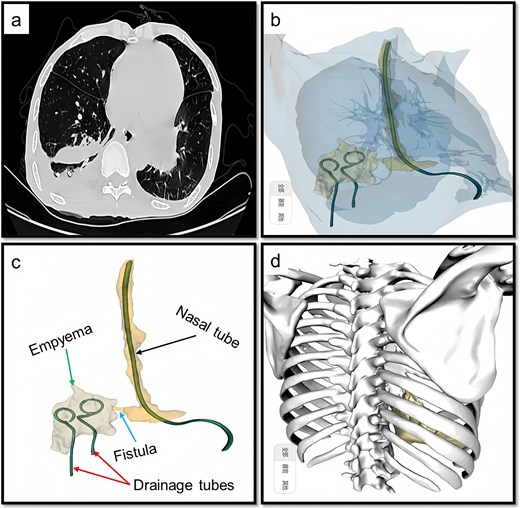 Preoperative CT and 3D reconstruction images. (a) CT revealed that the fistula and associated cavity remained unchanged. (b) 3D reconstruction provides a comprehensive visualization of the fistula and its associated cavity. (c) Demonstration of the details, we can see the fistula (arrow), empyema, nasal tube, and drainage tubes. (d), 3D reconstruction including bones, the 10th rib is situated at the center of the abscess, and accordingly, the extent and number of rib dissections are determined based on this anatomical reference.