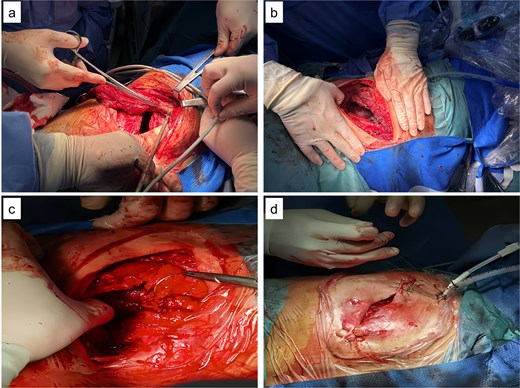 Intraoperative images. (a) Latissimus dorsi muscle flap with preserved blood supply; (b) rib transection and drainage tube placement; (c) muscle flap sutured into the cavity; (d) incision closure.