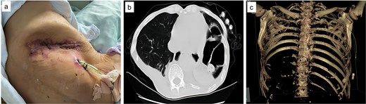 Postoperative images. (a) Fourteen days following the surgical procedure, the wound exhibited satisfactory healing. (b) One month after surgery, during the preparation for removal of the nasointestinal tube, a follow-up chest CT scan revealed that the abscess cavity had been completely filled. (c) Visual documentation of the removal of ribs 9th to 12th.