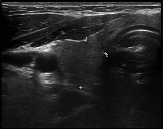 Right lobe hypoechoic nodule 0.5 × 0.4 cm TI-RADS 4.