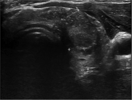 Left lobe lesion measuring 2.3 × 1.7 cm TI-RADS 5.