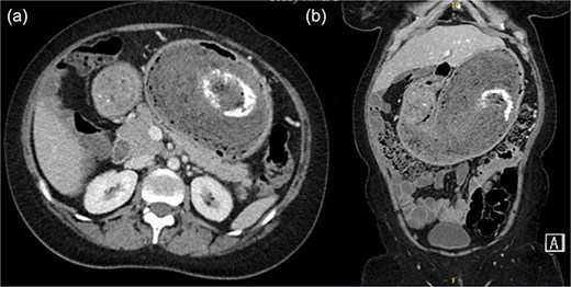 (a) Axial contrast-enhanced CT image of the abdomen showing a markedly distended stomach with a large intraluminal mass displaying a characteristic whorled appearance and internal foci of calcification (arrow), suggestive of a trichobezoar. (b) Coronal CT reconstruction demonstrating the full extent of the bezoar within the gastric lumen (arrow).