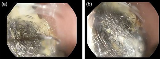 (a) Endoscopic view of the upper stomach showing a large, dense hairball (trichobezoar) occupying ˃90% of the gastric lumen. (b) Closer endoscopic image highlighting the compact hair fibers and matted texture preventing safe endoscopic extraction.