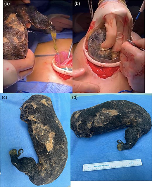 (a) Intraoperative view showing the distended stomach before gastrotomy. (b) Gastrotomy along the greater curvature with partial exposure of the trichobezoar. (c) Extraction of the bezoar as a single, intact mass. (d) Resected bezoar specimen laid out, demonstrating its size and typical hairball consistency.