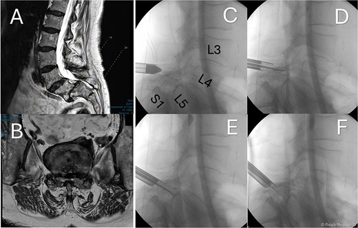Preoperative and intraoperative imaging of case 1. (A) Sagittal T2-weighted MRI demonstrating grade II degenerative spondylolisthesis at the L5/S1 level. (B) Axial T2-weighted MRI. (C–F) intraoperative fluoroscopic views illustrating the placement of the working channel and guidewire.