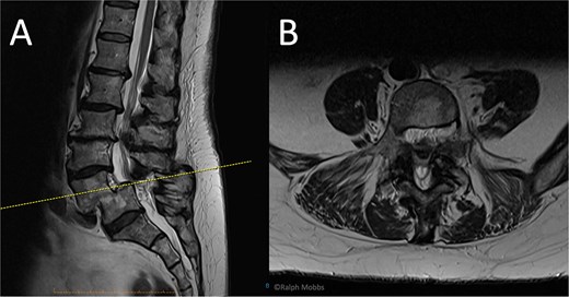 Preoperative MRI of case 2. (A) Sagittal T2-weighted showing L4/L5 spondylolisthesis. (B) Axial T2-weighted.