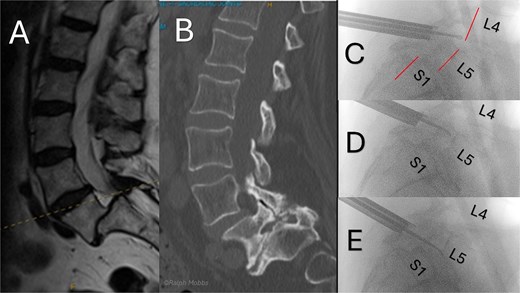 Preoperative and intraoperative imaging of case 3. (A) Sagittal T2-weigthed MRI demonstrating grade II+ degenerative spondylolisthesis at the L5/S1 level. (B) Sagittal CT demonstrating severe foraminal stenosis at L5/S1. (C–E) Intraoperative fluoroscopic images showing placement of the working channel and guidewire using forceps for targeted decompression.