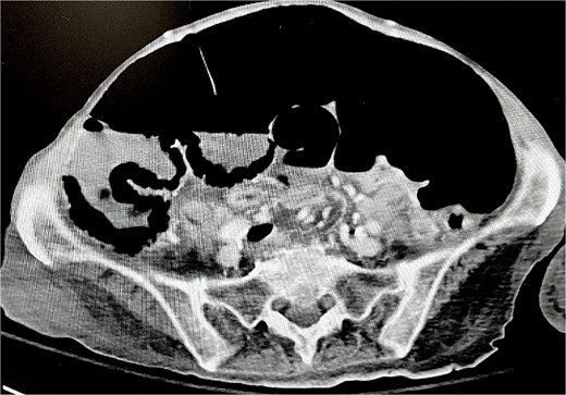 Development of cecal pneumatosis after administration of neostigmine.