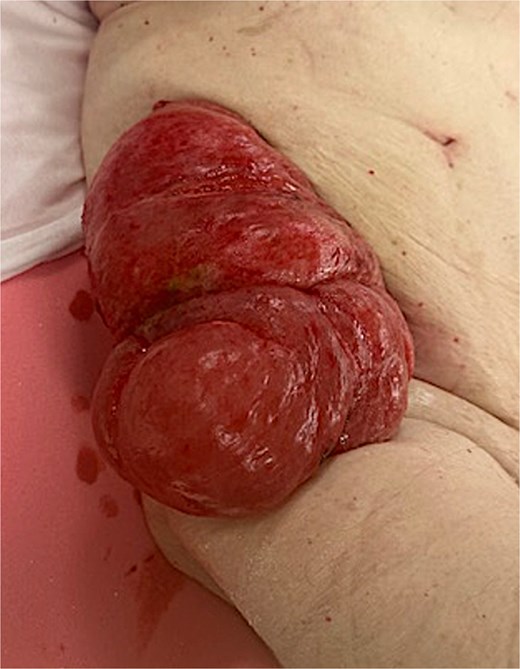 Anterior/posterior view of incarcerated cecostomy intussusception.