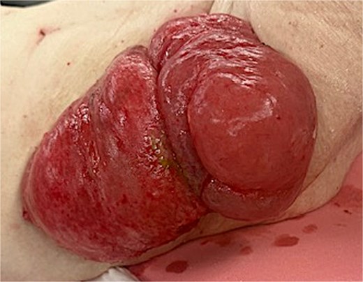 Lateral view of incarcerated cecostomy intussusception.