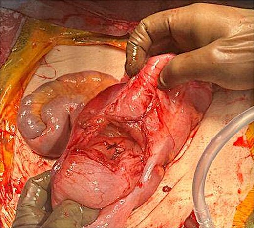 Successful eversion and reduction of cecostomy intussusception.