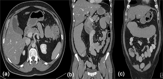 Contrast enhanced CT scan of the abdomen showing a heterogeneously enhancing lesion at the splenic flexure with upstream dilatation of the transverse and ascending colon.