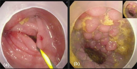 Colonoscopy images: (a) showed tight stricture with normal looking mucosa at the splenic flexure ⁓47 cm from anal verge, (b) shows successfully deployed Niti-S enteral colonic uncovered stent (type D) at the stricture site.