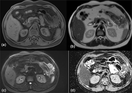 MRI of the abdomen showing: (a) T1 weighted image showing isointense exophytic mass at the splenic flexure with close proximity to the abdominal wall and inferior pole of the spleen. (b) T2 weighted image showing heterogeneously hypo-to isointense signal. (c, d) Diffusion weighted images with no diffusion restriction within the mass.