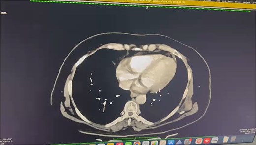 Axial CECT image shows a short segment of asymmetric enhancing wall thickening involving the proximal to mid-jejunal loop (8 cm). There is luminal narrowing at the site of thickening, with adjacent fat stranding and mesenteric lymphadenopathy.