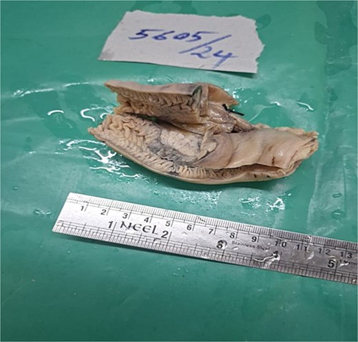 Resected specimen of jejunum measuring ⁓10 cm in length. External surface shows a sessile polypoid mass measuring (4 × 3 cm).Cut surface reveals multiple small, gray–white, speckled areas corresponding to the underlying lesion. The mucosal surface overlying the mass is ulcerated and shows a sessile protrusion (3.5 × 2 cm).