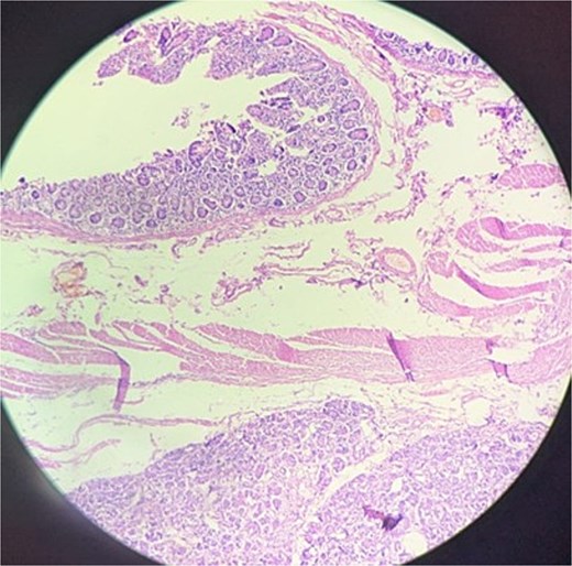 Histopathology of resected mass showing ectopic pancreatic tissue with pancreatic acini, islets of Langerhans, and dilated ducts in the submucosa and muscularis.