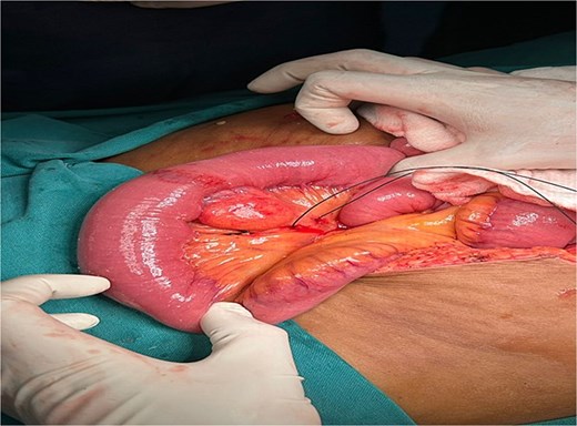 Intraoperatively, a firm, nodular lesion was identified arising from the jejunal wall. The lesion was submucosal in origin and well circumscribed without any evidence of infiltration into adjacent structures. Surrounding jejunal loops appeared normal without features of obstruction, ischemia, or perforation.