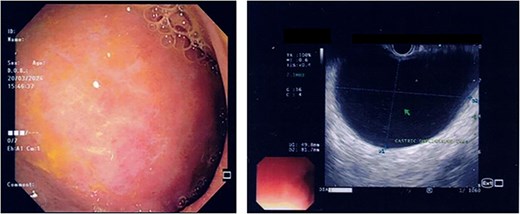 Endoscopic images demonstrate a subepithelial mass externally compressing the antrum. Endosonography revealed a well-defined, homogenous lesion with delineation across multiple gastric wall layers.