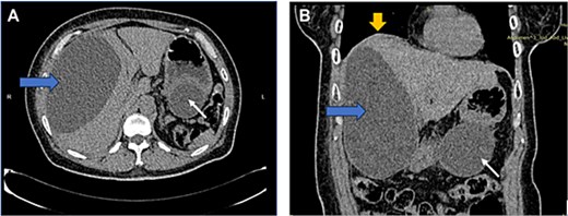 CT image: Axial (A) and coronal (B) view showing a well-defined, homogenous cystic lesion (white arrow) arising from the greater curvature of the stomach. Dimensions were ~ 62/79/147 mm with evidence of external compression to the cardia, fundus, and greater curvature. Another large cystic mass (horizontal arrow) originated from the right liver lobe, measuring 91/146/172 mm. Mass effect was noted with superior displacement of the right hemidiaphragm (vertical arrow). No suspicious or aggressive features of these cystic lesions.