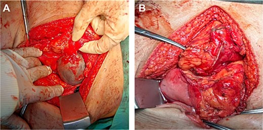 Intraoperative image of GDC before rupturing (A), showing a distinct, well-circumscribed mass measuring ~ 10 × 10 cm with adherence to the posterior stomach wall and tail of the pancreas. Upon excision of the cyst (B) via endo stapler, the staple line along the stomach was further reinforced with sutures.