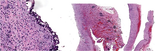 Histology image: Sections show a non-communicating cystic structure with a well-defined smooth muscle layer. No atypia or malignancy. The epithelium is flattened without atypia and occasional mucin-producing cells. Focal granulation tissue seen within smooth muscle bundles.