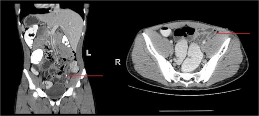 Coronal (left) and axial (right) CT images of the abdomen demonstrating situs inversus totalis with the liver located on the left side and spleen on the right. The inflamed appendix is seen in the left iliac fossa, with mural thickening and a visible appendicolith (arrow), consistent with acute appendicitis.
