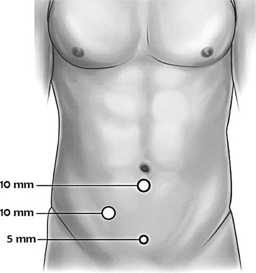 Schematic illustration of mirror-image port placement for laparoscopic appendectomy in a patient with situs inversus totalis. Three ports were used: a 10 mm camera port at the umbilicus, a 10 mm working port in the right lower quadrant (mirror of standard left-sided placement), and a 5 mm assistant port in the supra-pubic area. The operating surgeon and assistant stood on the patient's right side, with the monitor positioned to the left.