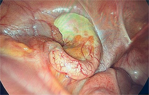 Intraoperative image of inflamed appendix in the left iliac fossa.