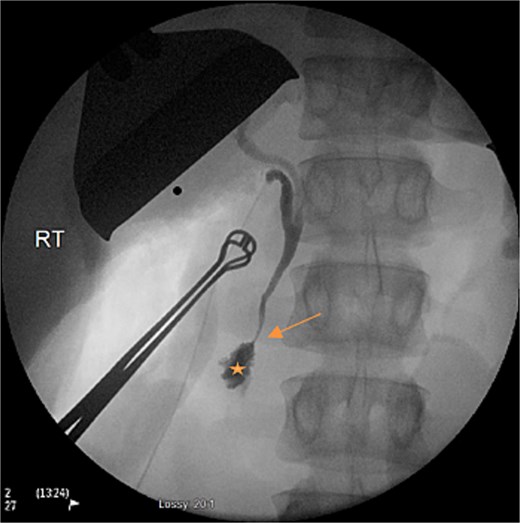 Intraoperative cholangiogram on second-look laparotomy demonstrating the lack of filling of the main pancreatic duct (arrow), prior to contrast entering the duodenum (star).