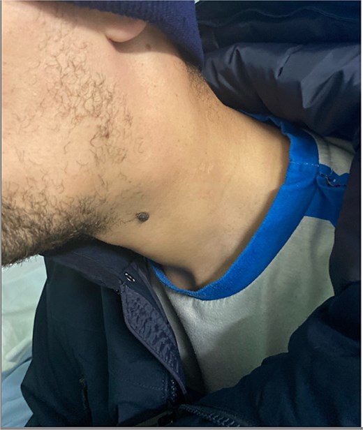 Clinical image showing a left-sided neck swelling in the anterior triangle.