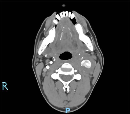 Axial CT angiography demonstrating the left common carotid artery aneurysm.