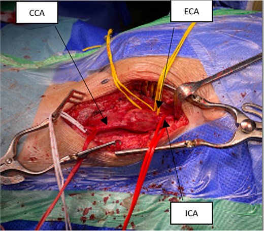 Intraoperative exposure showing aneurysm involving the carotid bulb; visible structures include CCA, ICA, and occluded ECA.