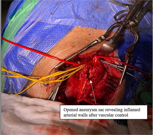 Opened aneurysm sac revealing inflamed arterial walls after vascular control.