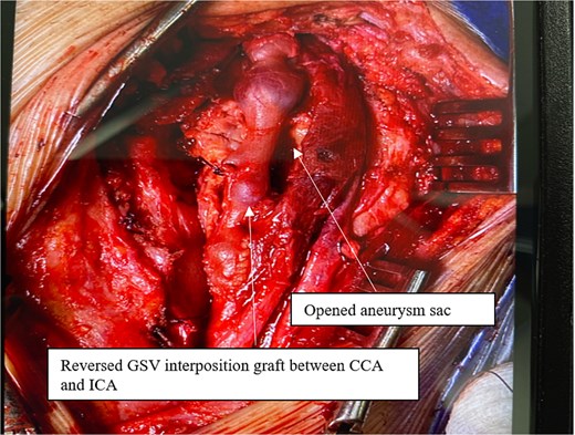 Completed repair with reversed GSV interposition graft between CCA and ICA; ECA is ligated.