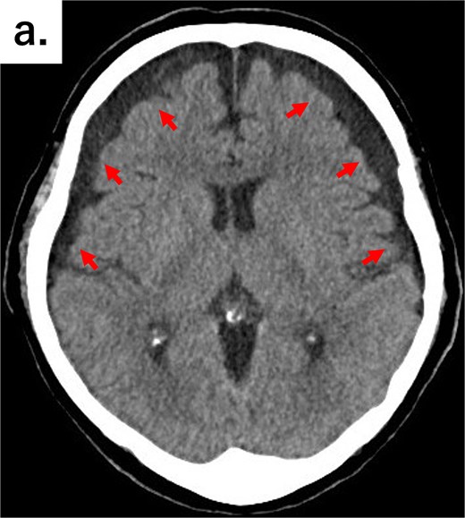 Axial CT image of the head showing bilateral chronic subdural hematomas (arrows).
