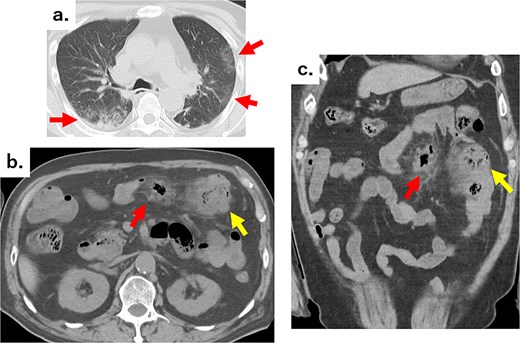 (a) Chest CT showing reticular shadows in both lung fields (arrows). (b) Axial and (c) coronal abdominal CT images showing scattered jejunal diverticula, abscesses in part of the mesentery (arrows), and an air formation with increased density in the surrounding fatty tissue (arrows).