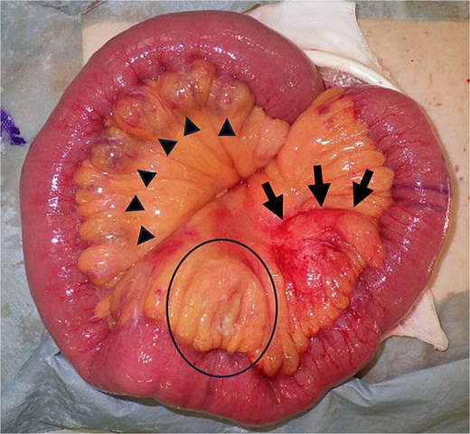 Macroscopic pathological specimen showing a series of diverticula measuring 2–5 cm in diameter, extending ~90 cm parallel to the mesentery of the jejunum, starting at the ligament of Treitz (triangles); a 5-cm mass with redness and hardness in the jejunal mesentery (arrows); and a change in hardness in the mesentery on the oral side (circle).