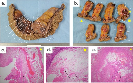 (a) A 30-cm small intestine segmental resection specimen showing a number of diverticula in the mesentery, a 5-cm mass with an abscess and bleeding, and an abscess in the mesentery on the oral side of the mass. The white lines marked with letters correspond to the slices shown in Fig. 4b. (b) Cross-sectional specimens showing scattered hard white nodules and abscess cavities. The two regions of inflammation are independent of each other, with no connections. The yellow triangle, square, and star correspond to Fig. 4c–e, respectively. (c) Microscopic image (hematoxylin–eosin staining, original magnification: ×4) showing the interrupted mucous membrane (arrow) and a collection of inflammatory cells, with bleeding in the surrounding area. (d) Microscopic image (hematoxylin–eosin staining, original magnification: ×4) showing the interrupted muscular layer (arrows). This diverticulum was a false diverticulum. (e) Microscopic image (hematoxylin–eosin staining, original magnification: ×4) showing the interrupted mucous membrane (arrow) and a collection of inflammatory cells, with bleeding in the surrounding area.