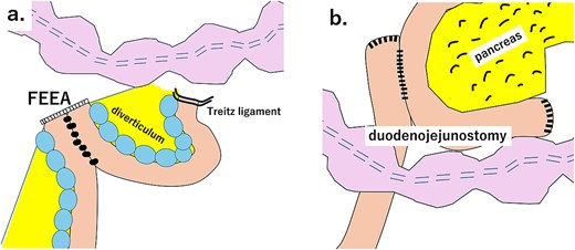 (a). Schematic diagram of partial resection of the small intestine and FEEA. (b) Schematic diagram of total resection of the small intestine diverticulum and duodenojejunostomy.