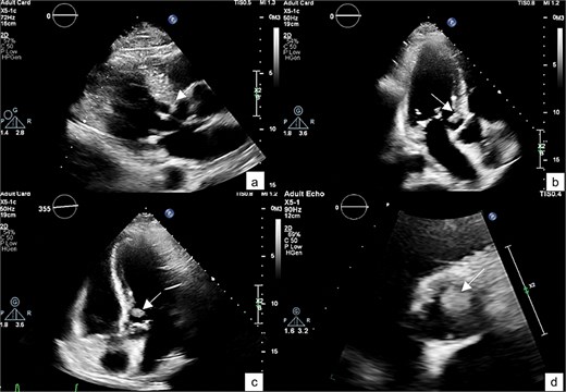 A TTE showing a small-rounded mass attached to the LV septum (arrow), which can be seen protruding into the LVOT in various echocardiographic views: Parasternal view (a), parasternal long axis view (b), 5-chamber view (c), and short-axis view of aortic valve (d).