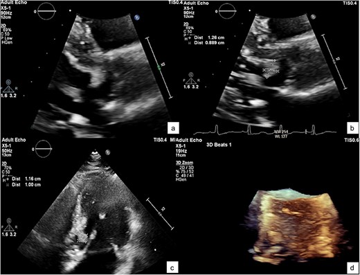 A zoomed-in view of the mass with measurements of 1.2 × 1 × 0.9 cm (a–c) and in 3D echocardiography (d).