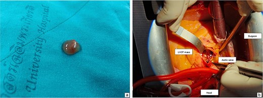Intraoperative view showing mass attached to the left ventricular outflow tract (a). A gross specimen of the excised mass (b).