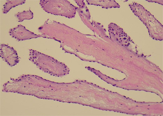 A histological view of the excised mass reveals elongated and branching papillary fronds with central avascular collagen, lined by hyperplastic epithelial cells.