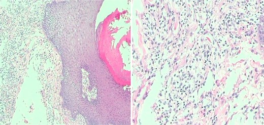 Intraoperative pathological examination of resected lesions demonstrating chronic skin inflammation.