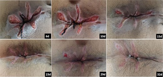 Postoperative wound healing progression and skin changes. Numbers in the lower-right corner indicate postoperative days.