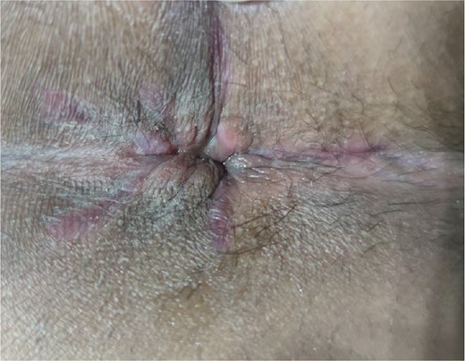 Near-complete recovery observed on day 40 post-surgery.