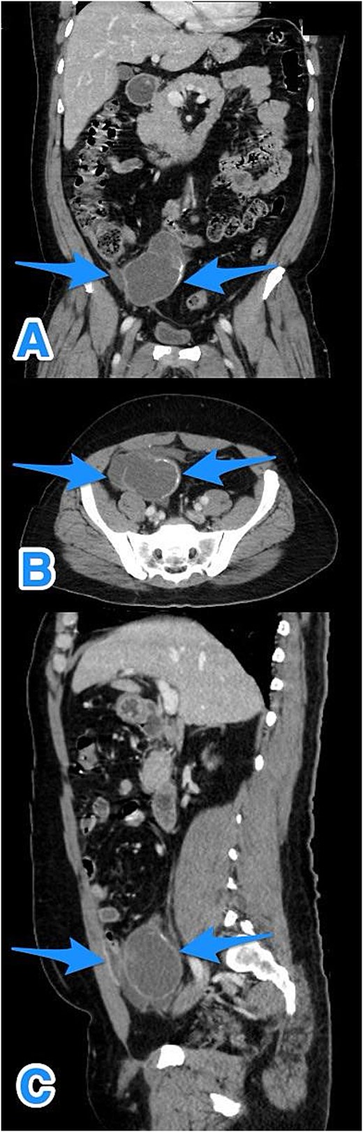 Multiview contrast-enhanced CT images of the perforated appendix with associated free fluid: (A) coronal view, (B) axial view, and (C) sagittal view (arrows).