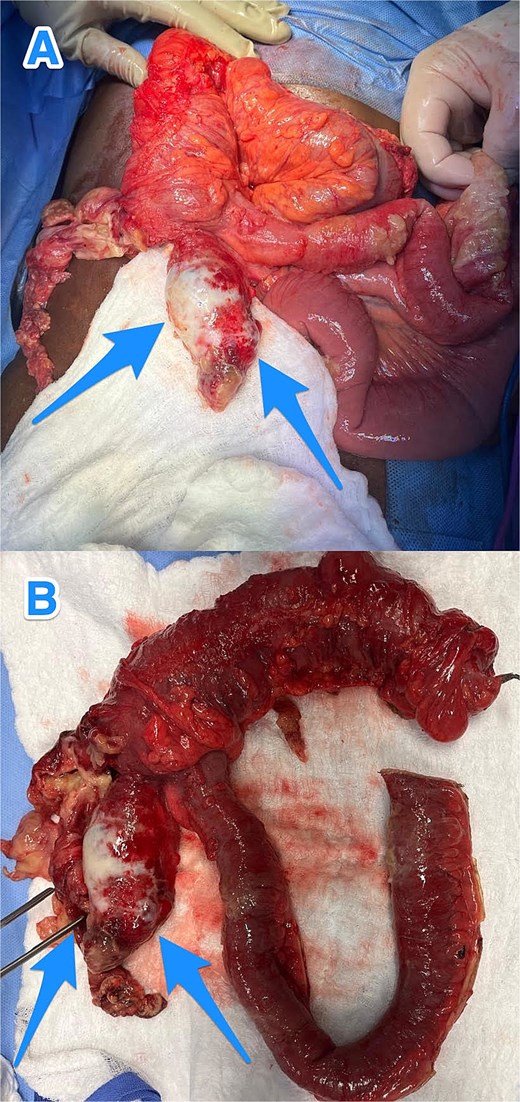 Intraoperative views (A and B) showing an inflamed, dilated, and ruptured appendix with mucin present at the tip (arrows).